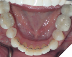 58-year-old female patient who
received orthodontic treatment 20
years ago. She still has the original
well-maintained upper 2-2 and lower
3-3 bonded permanent retainers. She
was referred by her dentist to increase
the thickness of the orthodontic
resin.