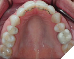 58-year-old female patient who received orthodontic treatment 20 years ago. She still has the original well-maintained upper 2-2 and lower 3-3 bonded permanent retainers. She was referred by her dentist to increase the thickness of the orthodontic resin.