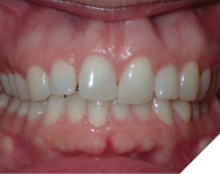 47-year-old female patient
who received orthodontic treatment
30 years ago. She has the poorly
maintained upper 2-2 bonded
permanent retainer. She experiences
premature contact at upper left
central incisor while speaking that
forces her jaw back. She was referred
by her dentist for a comprehensive
orthodontic treatment to restore
the functionality of the bite and the
aesthetics of the smile.