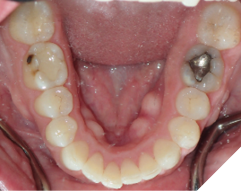 47-year-old female patient
who received orthodontic treatment
30 years ago. She has the poorly
maintained upper 2-2 bonded
permanent retainer. She experiences
premature contact at upper left
central incisor while speaking that
forces her jaw back. She was referred
by her dentist for a comprehensive
orthodontic treatment to restore
the functionality of the bite and the
aesthetics of the smile.