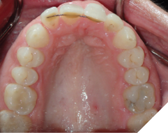 47-year-old female patient
who received orthodontic treatment
30 years ago. She has the poorly
maintained upper 2-2 bonded
permanent retainer. She experiences
premature contact at upper left
central incisor while speaking that
forces her jaw back. She was referred
by her dentist for a comprehensive
orthodontic treatment to restore
the functionality of the bite and the
aesthetics of the smile.