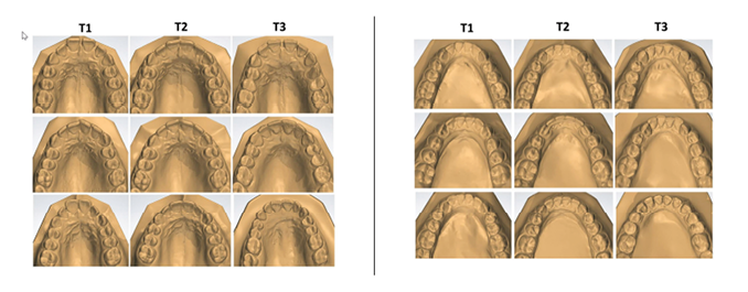 Some patients of the nonextraction treated group illustrating different degrees of maxillary and mandibular incisor changes (T1, initial, T2, final and T3, long-term post-treatment follow up)