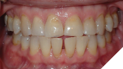 63-years-old female patient who had orthodontic treatment 49 years ago. She started to use Anti-snoring device which positions her tongue as seen on the advertisement 18 months ago. She has developed anterior open bite and dental spacing in the lower dental arch. She is unable to bite into her food and has become very self-conscious about her smile .