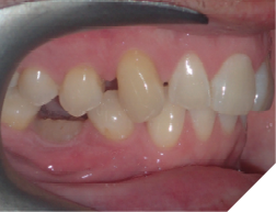 52-years-old male patient who never had orthodontic treatment. He has congenitally missing LR5, LL4, over-retained LLd,Lle,LRe, over-eruption of UL4, lingually displaced LL5 and significant rotations of premolars. He was referred by his oral maxillofacial surgeon to have the orthodontic treatment plan in place before proceeding with the extraction of over-retained baby teeth and the implant restoration of the congenitally missing teeth.