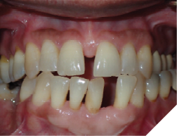 66-years-old female patient presents with a chief concern of “widening gaps between teeth” Her dental history is significant for dental extractions and periodontal surgeries. She noted that the dental spacing increased continuously over time and affecting her chewing now. Her panoramic x-ray shows generalized reduced periodontal support. A multidisciplinary treatment is required to restore the functionality and the aesthetics of the occlusion.