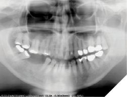 66-years-old female patient presents with a chief concern of “widening gaps between teeth” Her dental history is significant for dental extractions and periodontal surgeries. She noted that the dental spacing increased continuously over time and affecting her chewing now. Her panoramic x-ray shows generalized reduced periodontal support. A multidisciplinary treatment is required to restore the functionality and the aesthetics of the occlusion.