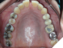 66-years-old female patient presents with a chief concern of “widening gaps between teeth” Her dental history is significant for dental extractions and periodontal surgeries. She noted that the dental spacing increased continuously over time and affecting her chewing now. Her panoramic x-ray shows generalized reduced periodontal support. A multidisciplinary treatment is required to restore the functionality and the aesthetics of the occlusion.