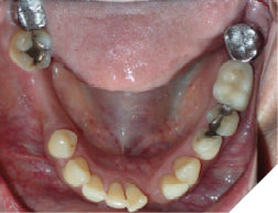 66-years-old female patient presents with a chief concern of “widening gaps between teeth” Her dental history is significant for dental extractions and periodontal surgeries. She noted that the dental spacing increased continuously over time and affecting her chewing now. Her panoramic x-ray shows generalized reduced periodontal support. A multidisciplinary treatment is required to restore the functionality and the aesthetics of the occlusion.