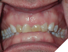 56-years-old male patient who never had orthodontic treatment. He suffers from bruxism and wears a nightguard every night. He was referred by his prosthodontist to complete orthodontic treatment in order to have occlusal clearance for full mouth rehabilitation to restore his reduced vertical dimension of occlusion and heavily worn dentition.