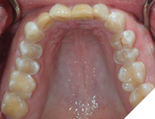 56-years-old male patient who never had orthodontic treatment. He suffers from bruxism and wears a nightguard every night. He was referred by his prosthodontist to complete orthodontic treatment in order to have occlusal clearance for full mouth rehabilitation to restore his reduced vertical dimension of occlusion and heavily worn dentition.