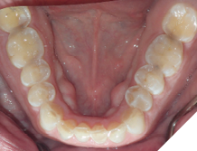 56-years-old male patient who never had orthodontic treatment. He suffers from bruxism and wears a nightguard every night. He was referred by his prosthodontist to complete orthodontic treatment in order to have occlusal clearance for full mouth rehabilitation to restore his reduced vertical dimension of occlusion and heavily worn dentition.