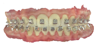The patient presents with a significant gap during his supervised retention period due to poor compliance with his retainers