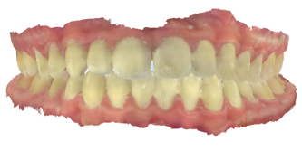 14 year 8 months old male patient’s pre-debond digital scan shows good alignment of upper and lower teeth. 