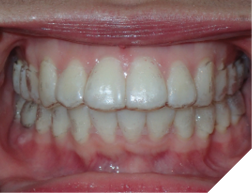 A well-fitting clear orthodontic retainer. 