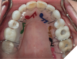  A well-fitting Hawley-type orthodontic retainer. 
