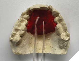 Palatal jig fabricated on a maxillary cast using Duralay resin.