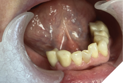 Composite buildups and single crown restorations at
the treatment VDO.