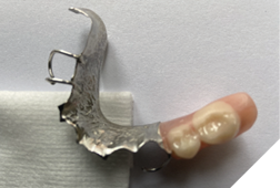 Cast mandibular partial denture.
