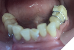 Cast mandibular partial denture.