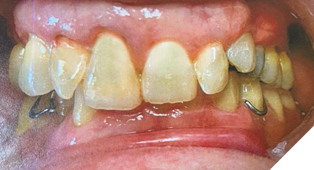 Cast mandibular partial denture.