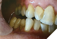 Final prosthesis demonstrating anterior and cuspid guidance during lateral excursions.