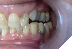 Final prosthesis demonstrating anterior and cuspid guidance during lateral excursions.