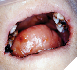 Mrs. A. Suffering from advanced xerostomia.