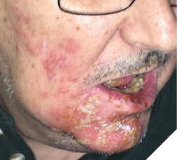 Extraoral Photo Mr. B.