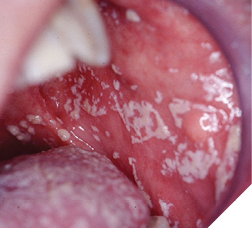  Mr. C Fungal infection.

