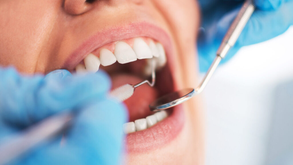 Higher potassium levels were found in dental calculus of patients with diabetes. (iStock)