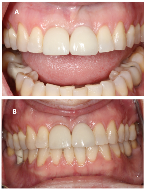 Clinical photographs of implant #11 at recall visits. A) 2021, one year after implant placement. B) 2025, five years post-placement. Although the tissues appear stable, differences in lip position, retraction, lighting, and camera angulation obscure subtle shifts. This highlights how clinical photography, while useful for documentation, often lacks the reproducibility needed to track peri-implant soft-tissue change.6