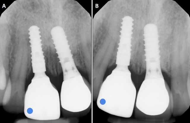 Periapical radiographs of implant #11 restoration. A) 2021, one-year post-placement. B) 2025, five years post-placement. Radiographs confirm maintained crestal bone levels and implant osseointegration (site marked by blue dot). However, they cannot capture subtle alterations in soft-tissue volume or contour, and even minor variations in X-ray beam angulation may create the appearance of change where none exists.