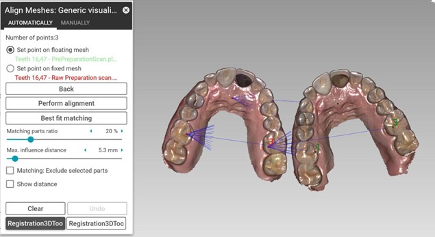 Alignment interface in exocadⓇ software. Baseline and recall scans are registered using stable reference points (blue vectors) on immobile structures such as enamel surfaces and palatal rugae. Gingival tissues are excluded from alignment to ensure reproducibility across visits.