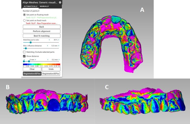 Colour-coded deviation maps generated from superimposed baseline and recall intraoral scans of Patient X. Deviations within ±0.1 mm are rendered as neutral, while pink zones indicate ≈0.2 mm soft-tissue reduction. A) Occlusal view demonstrating diffuse buccolingual reduction across maxillary arch. B) Frontal view highlighting localized change in the papillary-facial region adjacent to implant #11, consistent with early resorption of papillary height and facial contour. C) Lateral view confirming facial flattening of the peri-implant mucosa compared with baseline.