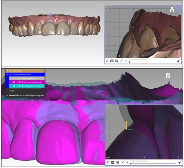 Cross-sections at implant #11 demonstrating vertical and horizontal soft-tissue change. A) Midfacial zenith displayed with native texture and no colour overlay; the 2025 recall surface is ≈0.42 mm apical to the 2021 baseline, indicating vertical mucosal (zenith) recession of ≈0.42 mm. B) Facial slice with colour overlays (pink =2025; purple = 2021); the 2025 outline is more palatal than the 2021 baseline, indicating a small horizontal buccolingual reduction of ≈0.24 mm. Together, these sections demonstrate measurable vertical and horizontal remodeling visible with digital superimposition.