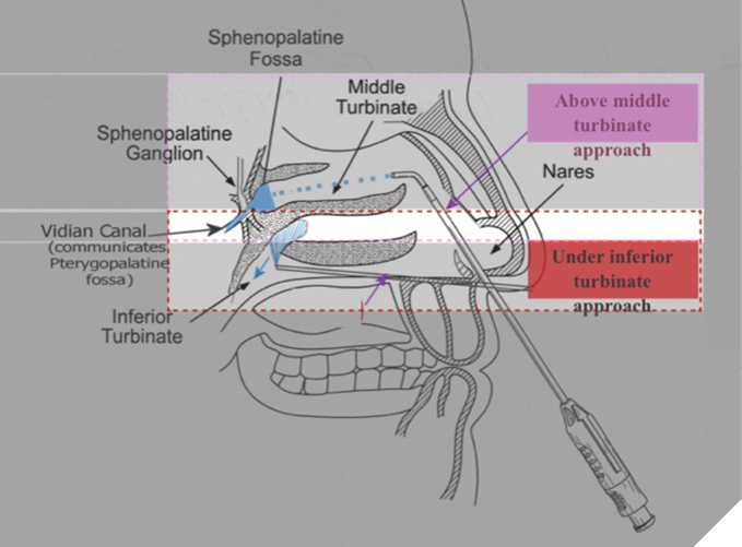Transnasal sphenopalatine ganglion block using the SphenoCath catheter.1