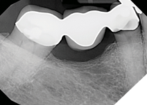 Optimizing endodontic treatment: Best practices and strategies to ...