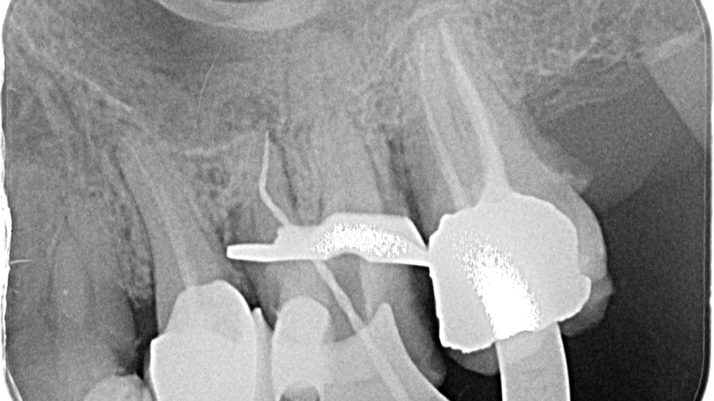 Conservative single-file reciprocating instrumentation of challenging ...