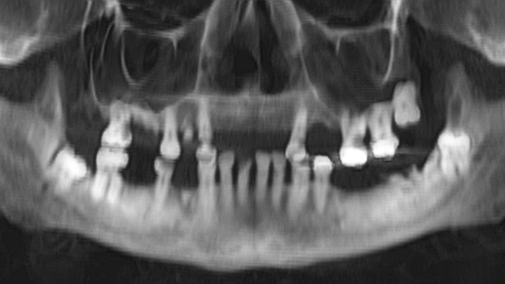 Cervicofacial necrotizing fasciitis of odontogenic origin: A case