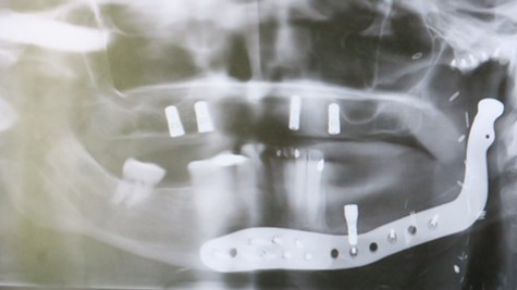 【SURGERY】bone embossing ma-1 The use of eTMJ prostheses and vascularized scapula composite
