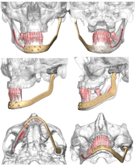 The use of eTMJ prostheses and vascularized scapula composite